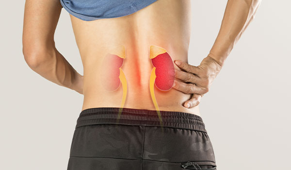 Kidney Stone Management