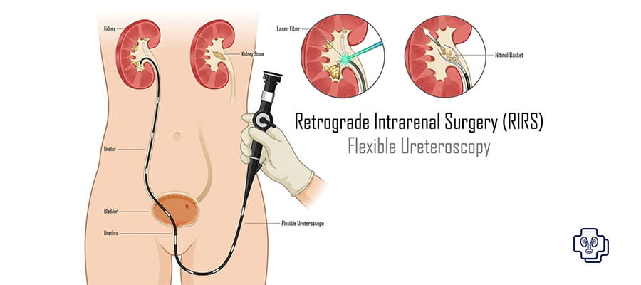 RIRS (Retrograde Intrarenal Surgery)